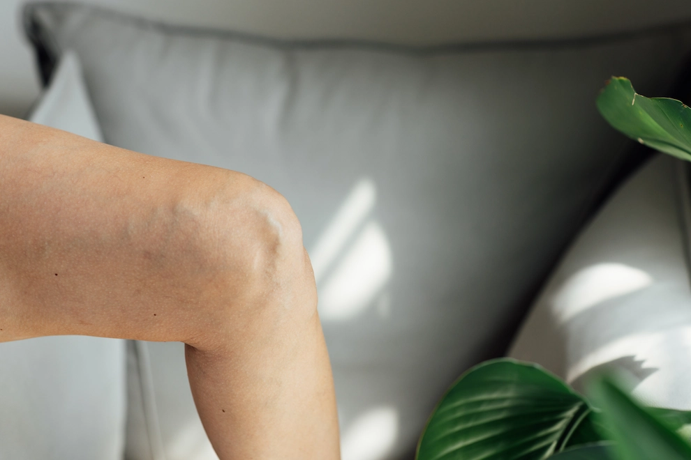 Frequently Asked Questions About Varicose Veins and Their Treatment
