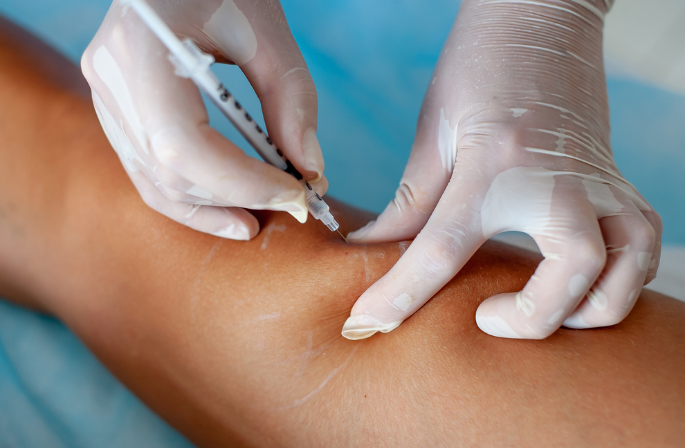 The Easy Way to Get Rid of Varicose Veins with Sclerotherapy