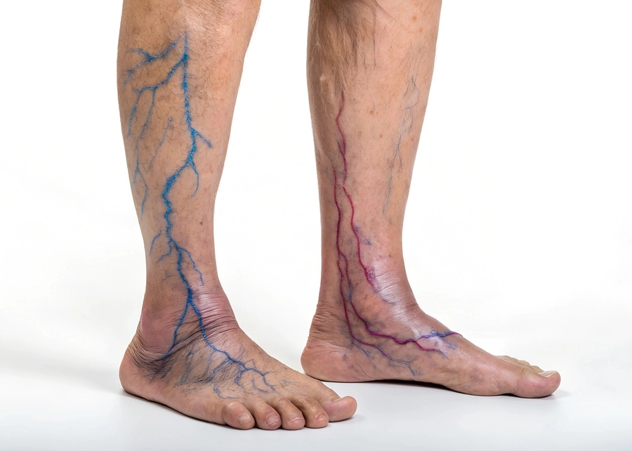 Is Ankle Swelling a Sign of Internal Varicose Veins, What Should Be Done