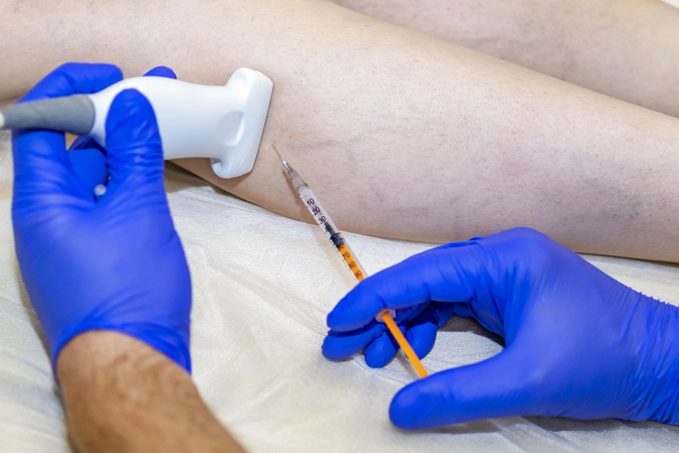 All the Details You Need to Know After Laser Varicose Vein Treatment