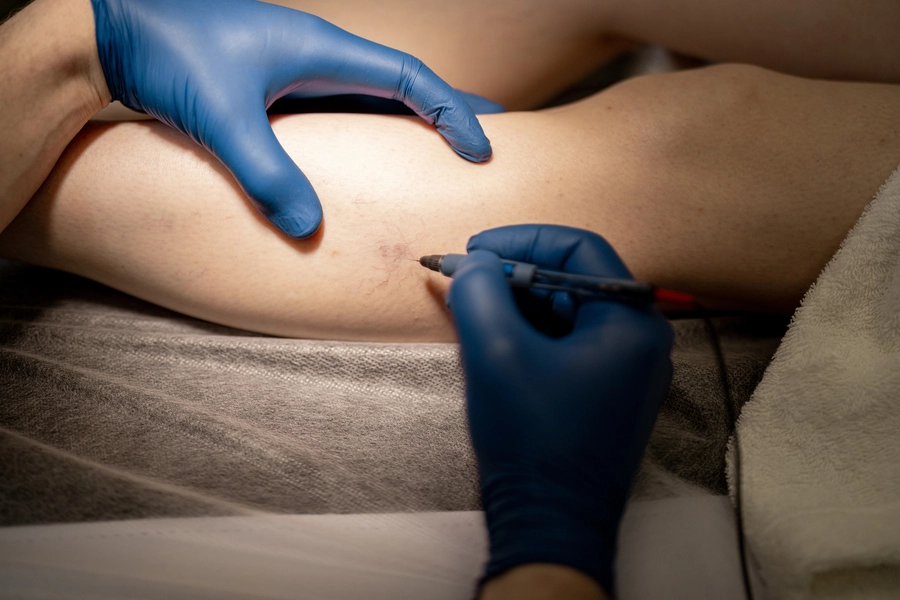 Non-Surgical Varicose Vein Treatment with Foam Sclerotherapy in Istanbul