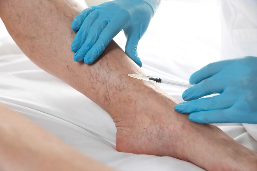 Sclerotherapy Treatment Istanbul - Personalized Sclerotherapy