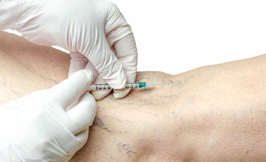 Sclerotherapy Treatment Prices Istanbul - Needle Vein Treatment