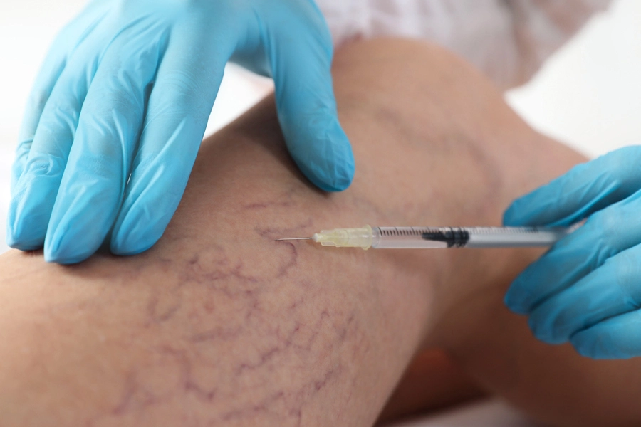 What is Sclerotherapy, Advantages of Sclerotherapy Treatment